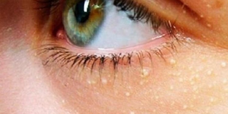 Kalp krizi ve inme riskine işaret eden yüzdeki sarı lekeler: Ksantalazma
